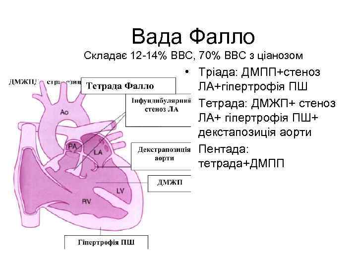 Вада Фалло Складає 12 -14% ВВС, 70% ВВС з ціанозом • Тріада: ДМПП+стеноз ЛА+гіпертрофія