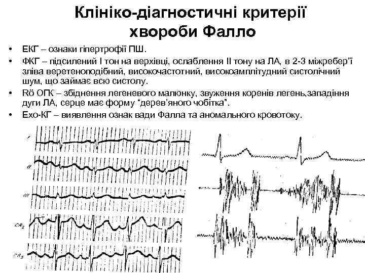 Клініко-діагностичні критерії хвороби Фалло • • ЕКГ – ознаки гіпертрофії ПШ. ФКГ – підсилений