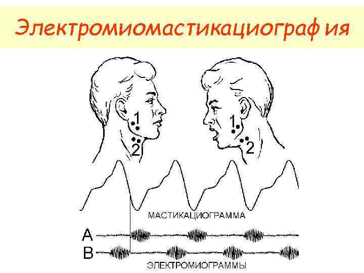 Электромиомастикациография 