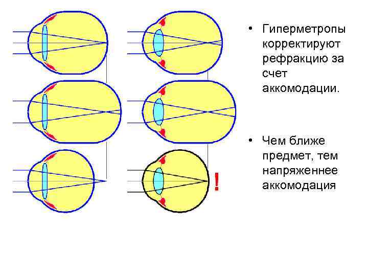  • Гиперметропы корректируют рефракцию за счет аккомодации. • Чем ближе предмет, тем напряженнее