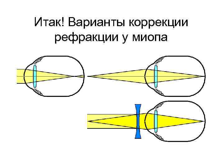 Итак! Варианты коррекции рефракции у миопа 