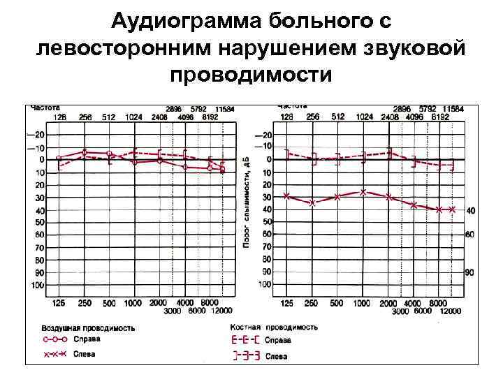 Аудиограмма больного с левосторонним нарушением звуковой проводимости 