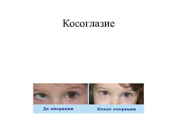 Косоглазие 