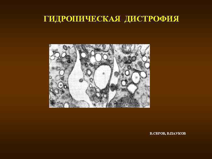 ГИДРОПИЧЕСКАЯ ДИСТРОФИЯ В. СЕРОВ, В. ПАУКОВ 