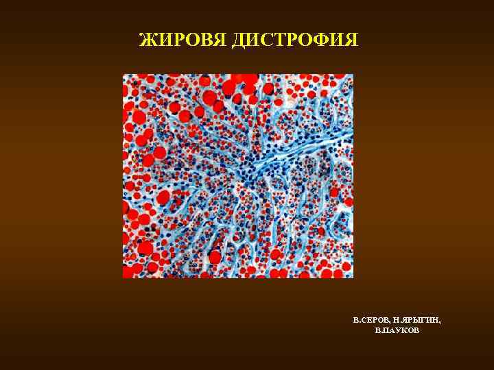 ЖИРОВЯ ДИСТРОФИЯ В. СЕРОВ, Н. ЯРЫГИН, В. ПАУКОВ 