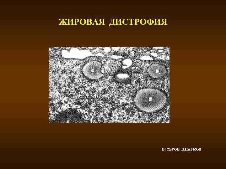 ЖИРОВАЯ ДИСТРОФИЯ В. СЕРОВ, В. ПАУКОВ 