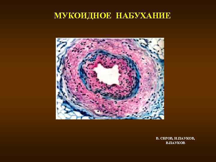 МУКОИДНОЕ НАБУХАНИЕ В. СЕРОВ, Н. ПАУКОВ, В. ПАУКОВ 