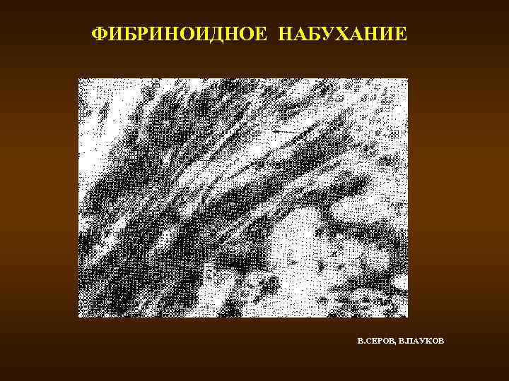 ФИБРИНОИДНОЕ НАБУХАНИЕ В. СЕРОВ, В. ПАУКОВ 
