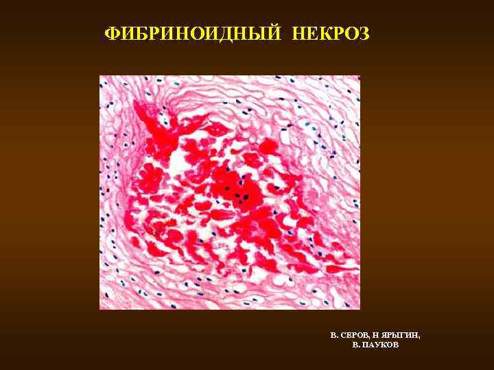 ФИБРИНОИДНЫЙ НЕКРОЗ В. СЕРОВ, Н ЯРЫГИН, В. ПАУКОВ 