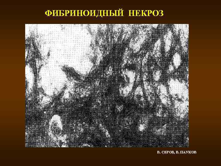 ФИБРИНОИДНЫЙ НЕКРОЗ В. СЕРОВ, В. ПАУКОВ 