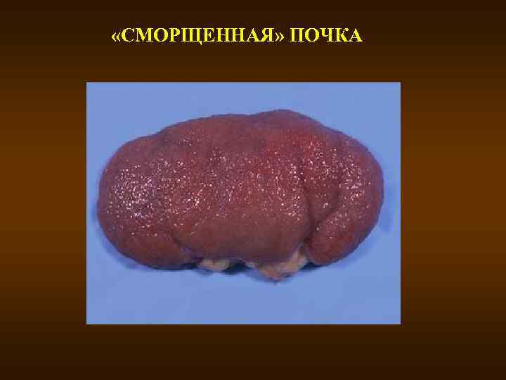  «СМОРЩЕННАЯ» ПОЧКА 