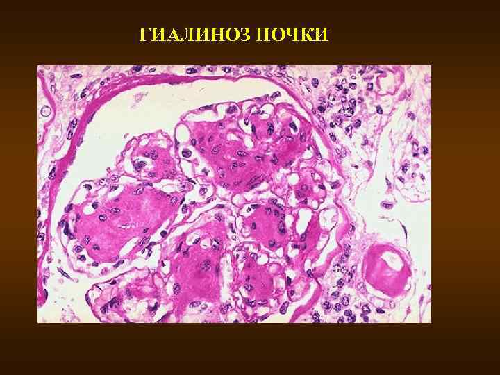 ГИАЛИНОЗ ПОЧКИ 