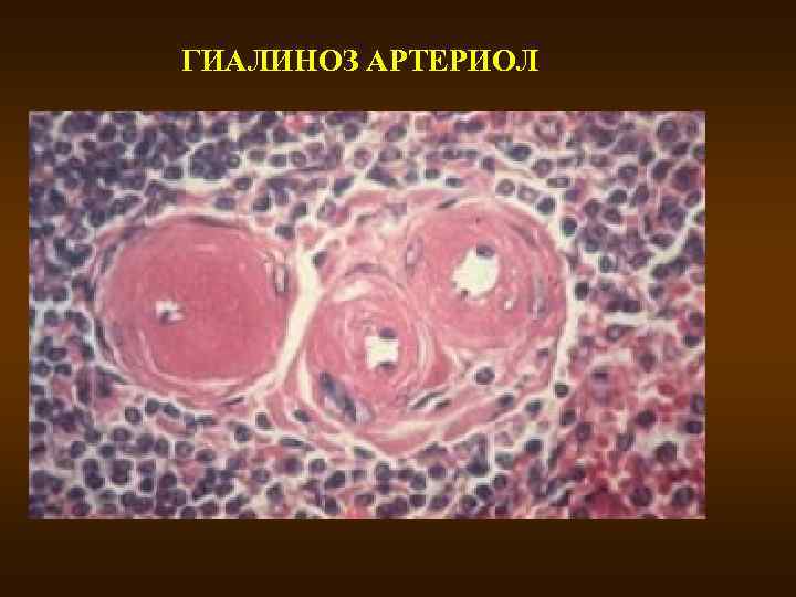 ГИАЛИНОЗ АРТЕРИОЛ 