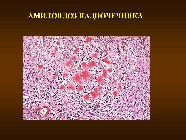 АМИЛОИДОЗ НАДПОЧЕЧНИКА 