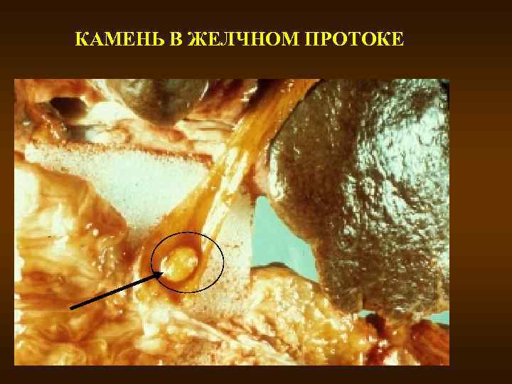 КАМЕНЬ В ЖЕЛЧНОМ ПРОТОКЕ 