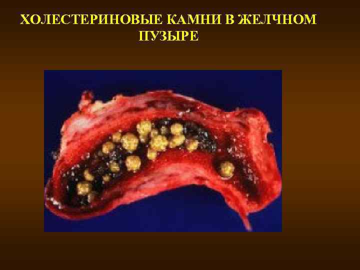 ХОЛЕСТЕРИНОВЫЕ КАМНИ В ЖЕЛЧНОМ ПУЗЫРЕ 