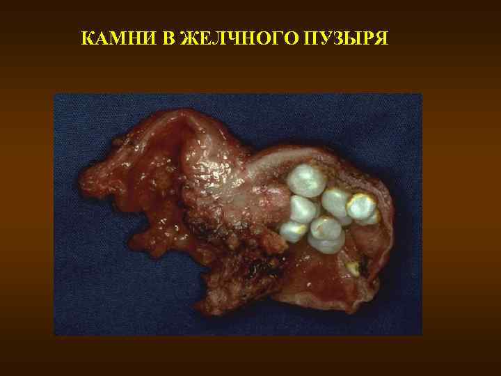 КАМНИ В ЖЕЛЧНОГО ПУЗЫРЯ 