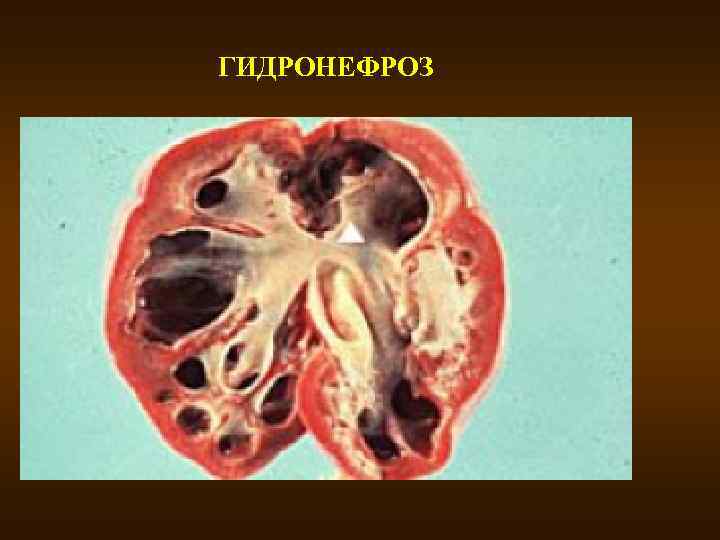 ГИДРОНЕФРОЗ 