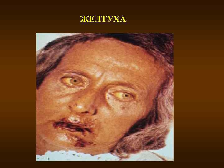ЖЕЛТУХА 