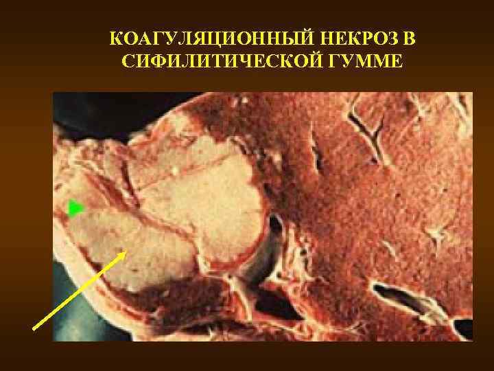 КОАГУЛЯЦИОННЫЙ НЕКРОЗ В СИФИЛИТИЧЕСКОЙ ГУММЕ 