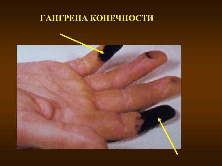 ГАНГРЕНА КОНЕЧНОСТИ 