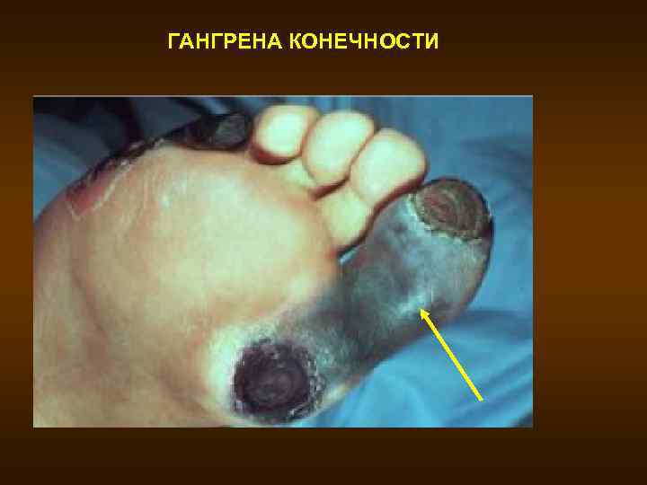 ГАНГРЕНА КОНЕЧНОСТИ 