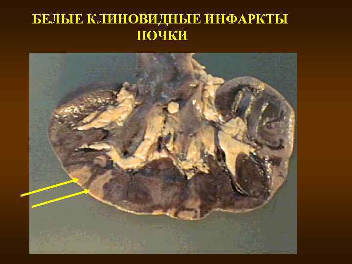 БЕЛЫЕ КЛИНОВИДНЫЕ ИНФАРКТЫ ПОЧКИ 