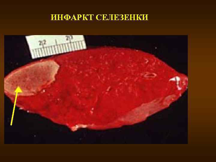 ИНФАРКТ СЕЛЕЗЕНКИ 