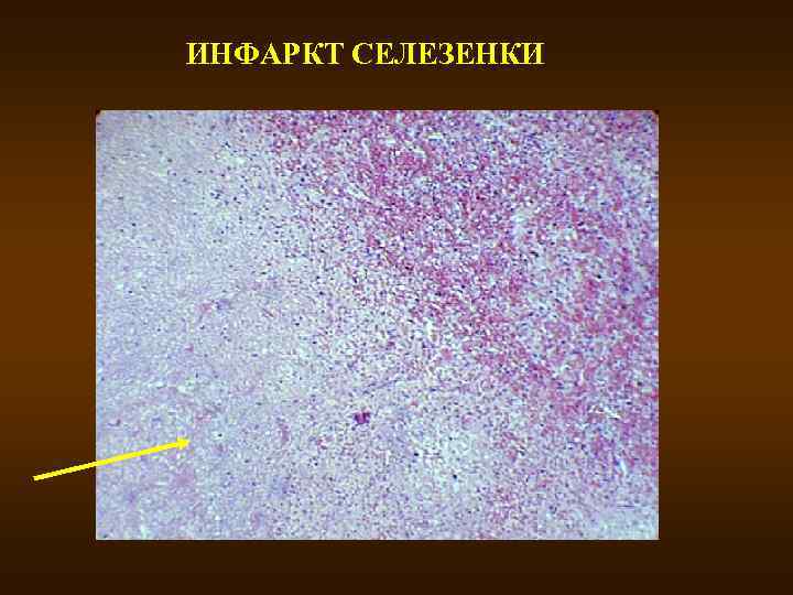 Ишемический инфаркт почки. Анемический инфаркт селезенки. Инфаркт селезенки макропрепарат. Геморрагический инфаркт селезенки микропрепарат. Инфаркт селезенки микропрепарат.