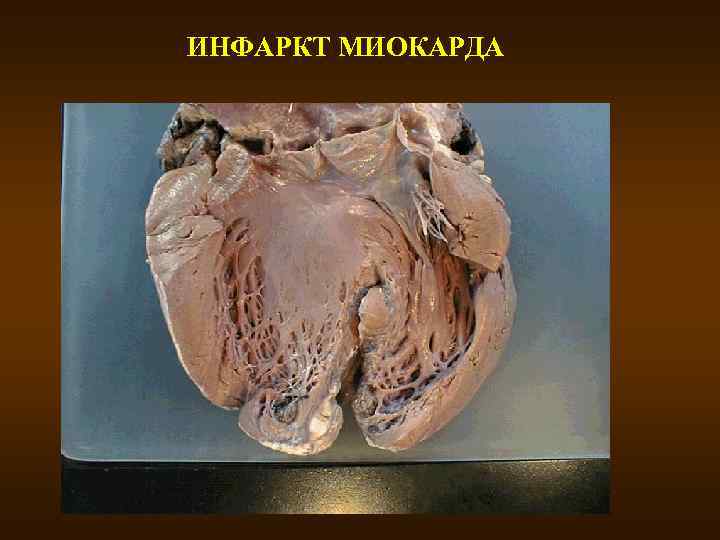 ИНФАРКТ МИОКАРДА 