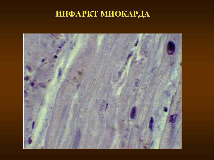 ИНФАРКТ МИОКАРДА 