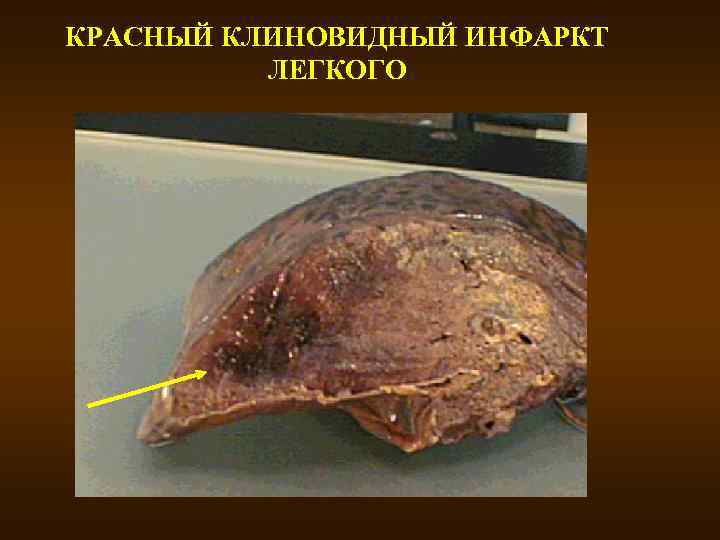 КРАСНЫЙ КЛИНОВИДНЫЙ ИНФАРКТ ЛЕГКОГО 