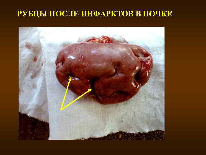 РУБЦЫ ПОСЛЕ ИНФАРКТОВ В ПОЧКЕ 