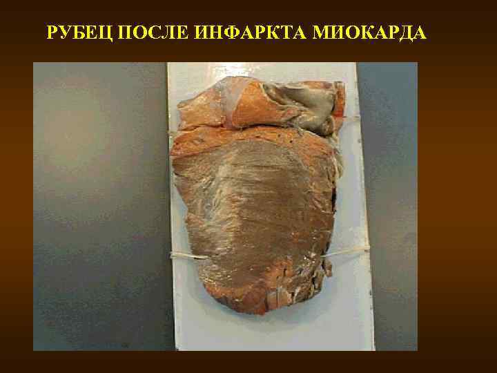 РУБЕЦ ПОСЛЕ ИНФАРКТА МИОКАРДА 