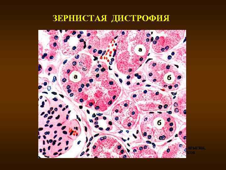 ЗЕРНИСТАЯ ДИСТРОФИЯ В. СЕРОВ, Н. ЯРЫГИН, В. ПАУКОВ 