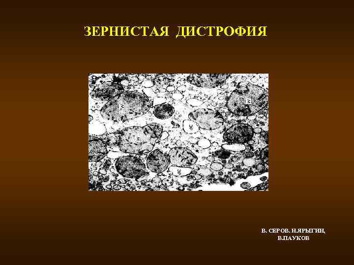 ЗЕРНИСТАЯ ДИСТРОФИЯ В. СЕРОВ. Н. ЯРЫГИН, В. ПАУКОВ 