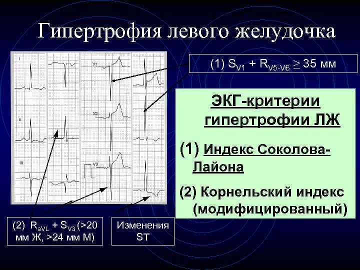 Гипертрофия левого желудочка (1) SV 1 + RV 5 -V 6 ≥ 35 мм