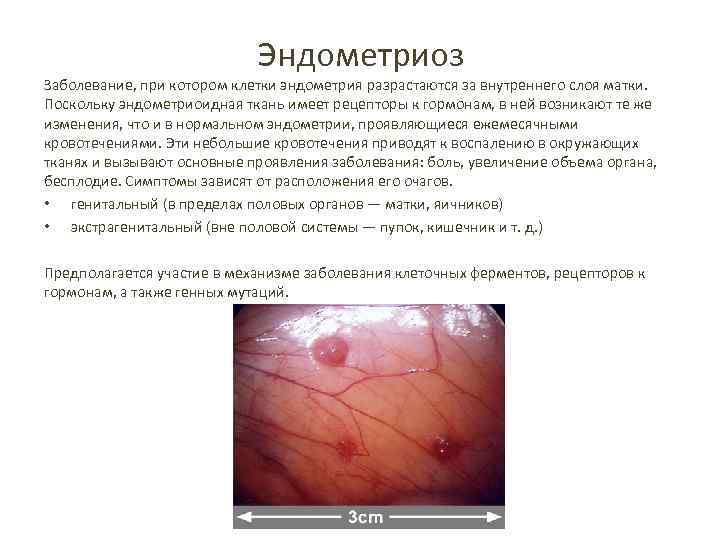 Эндометриоз Заболевание, при котором клетки эндометрия разрастаются за внутреннего слоя матки. Поскольку эндометриоидная ткань