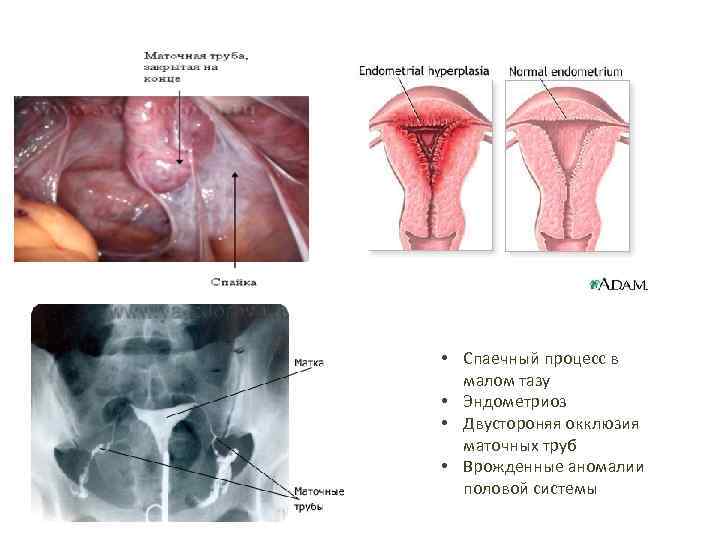  • Спаечный процесс в малом тазу • Эндометриоз • Двустороняя окклюзия маточных труб