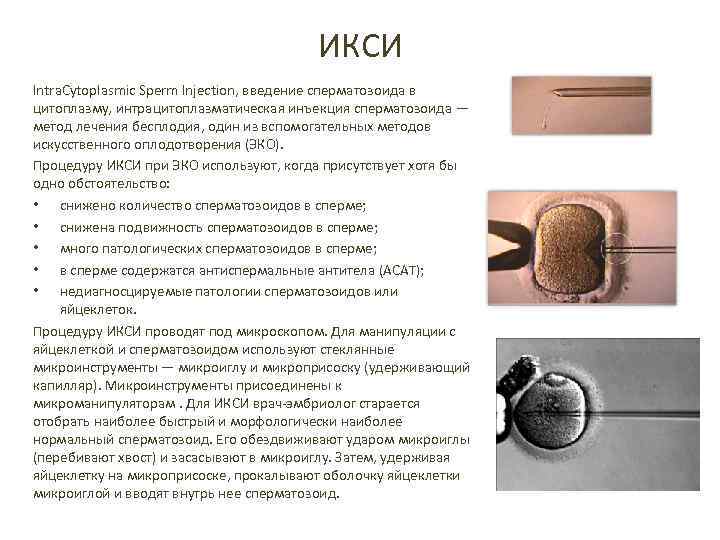 ИКСИ Intra. Cytoplasmic Sperm Injection, введение сперматозоида в цитоплазму, интрацитоплазматическая инъекция сперматозоида — метод