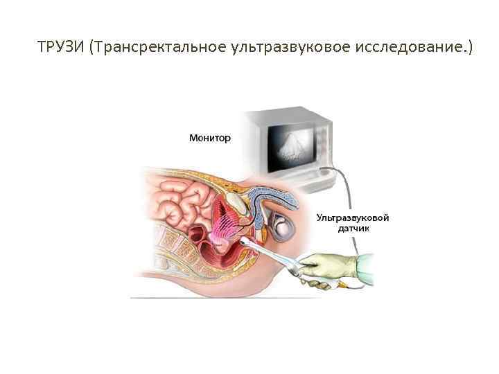 ТРУЗИ (Трансректальное ультразвуковое исследование. ) 
