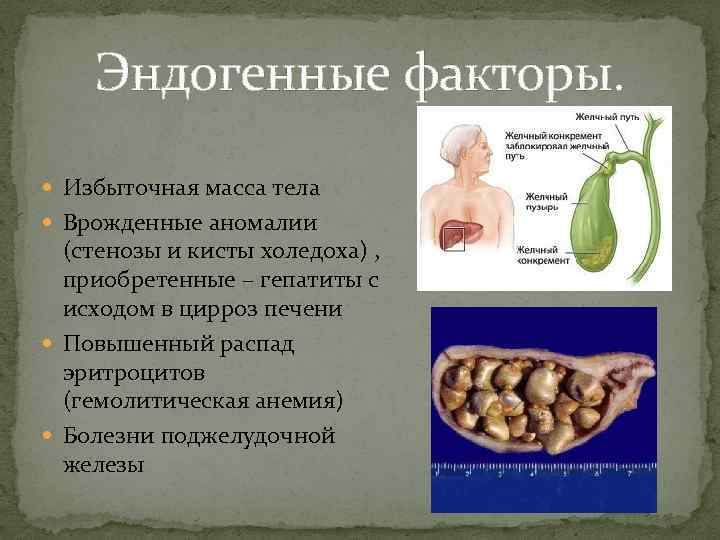 Эндогенные факторы. Избыточная масса тела Врожденные аномалии (стенозы и кисты холедоха) , приобретенные –