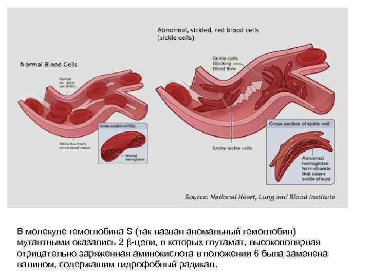 В молекуле гемоглобина S (так назван аномальный гемоглобин) мутантными оказались 2 β-цепи, в которых