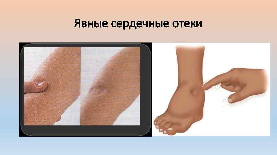 Явные сердечные отеки 