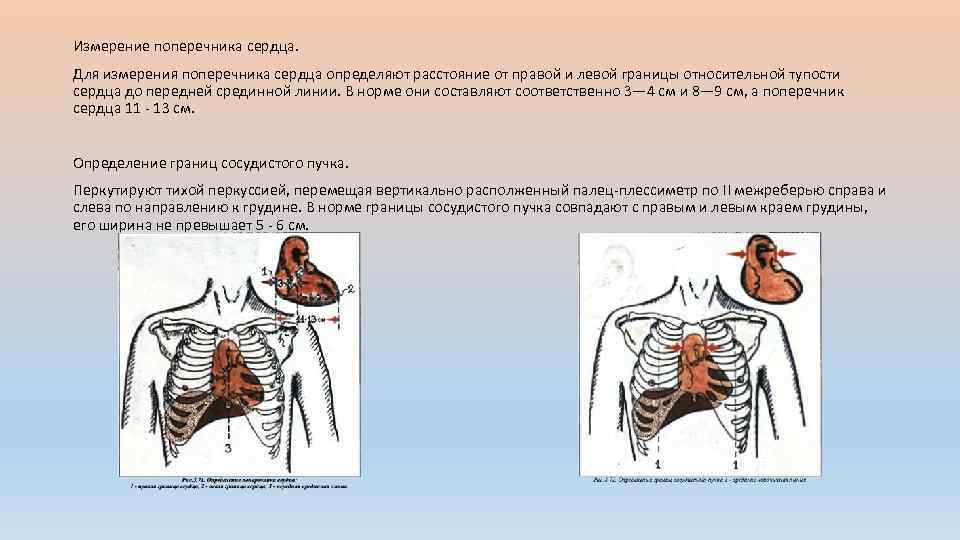Измерение поперечника сердца. Для измерения поперечника сердца определяют расстояние от правой и левой границы