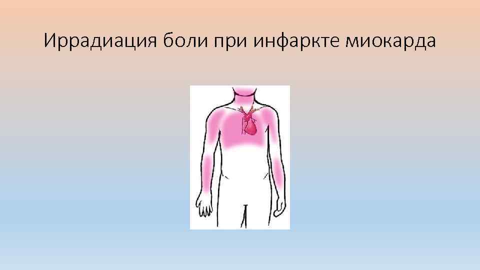 Иррадиация боли при инфаркте миокарда 