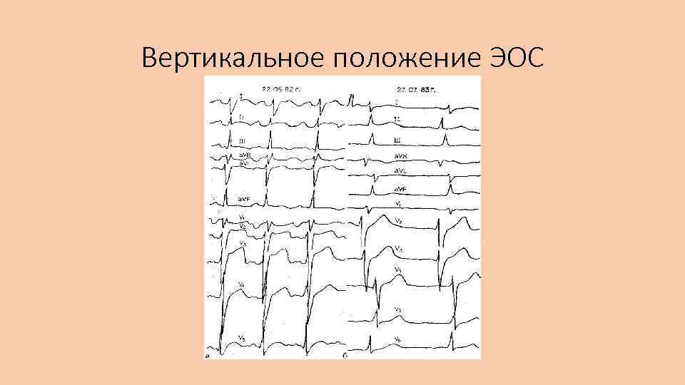 Горизонтальная эос. Вертикальное положение ЭОС. Позиция ЭОС вертикальная. Вертикальное расположение ЭОС. Синусовый вертикальное ЭОС.