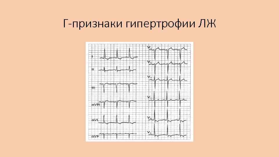 Г-признаки гипертрофии ЛЖ 