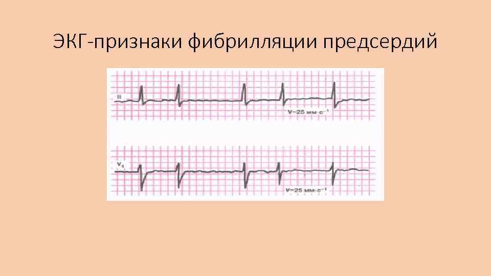 ЭКГ-признаки фибрилляции предсердий 