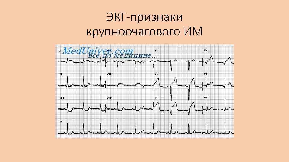 ЭКГ-признаки крупноочагового ИМ 
